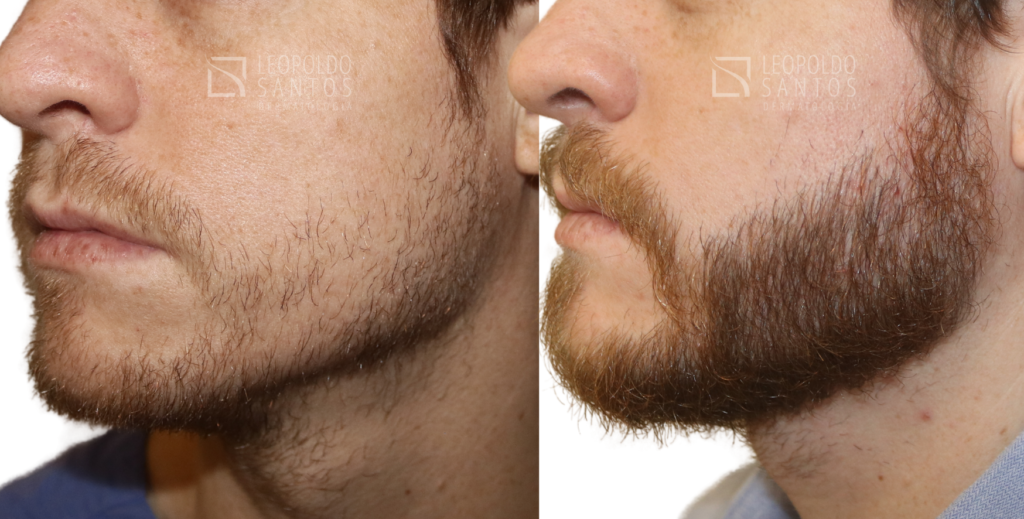 transplante de barba antes e depois