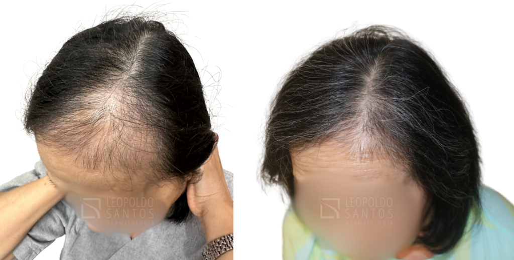 transplante capilar feminino antes e depois