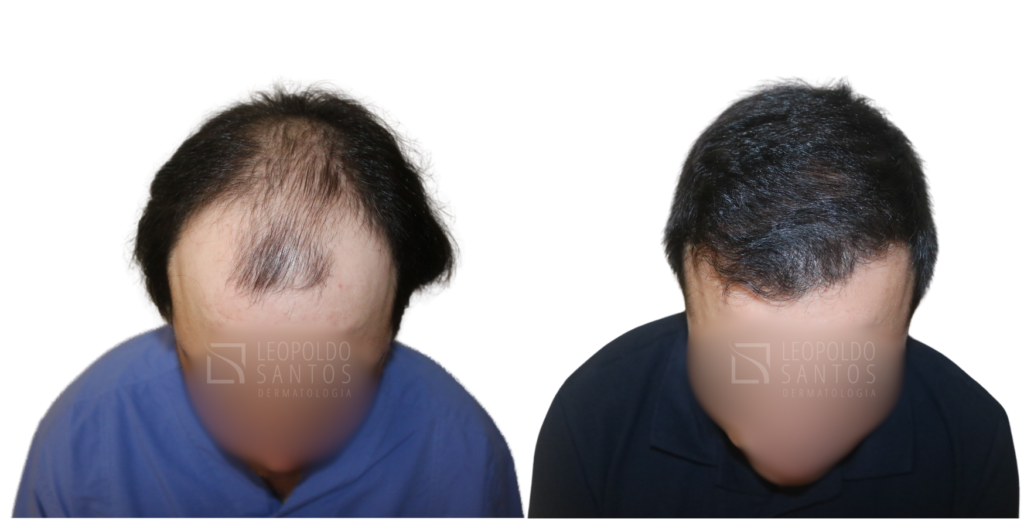 transplante capilar masculino antes e depois